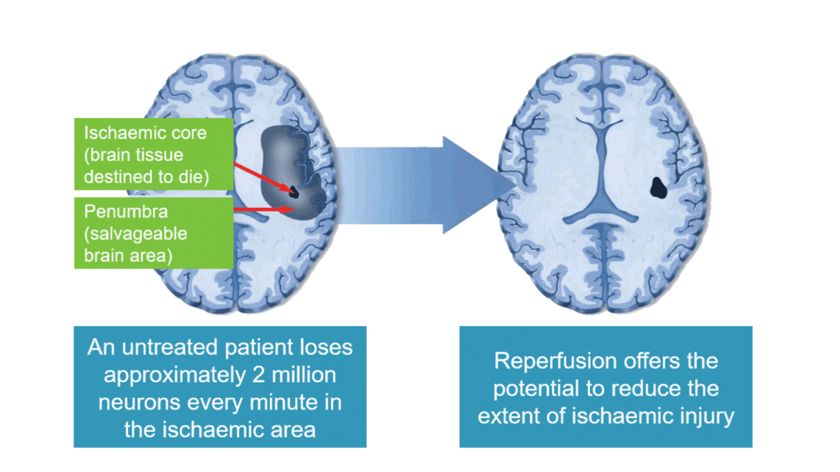 Stroke is an emergency
